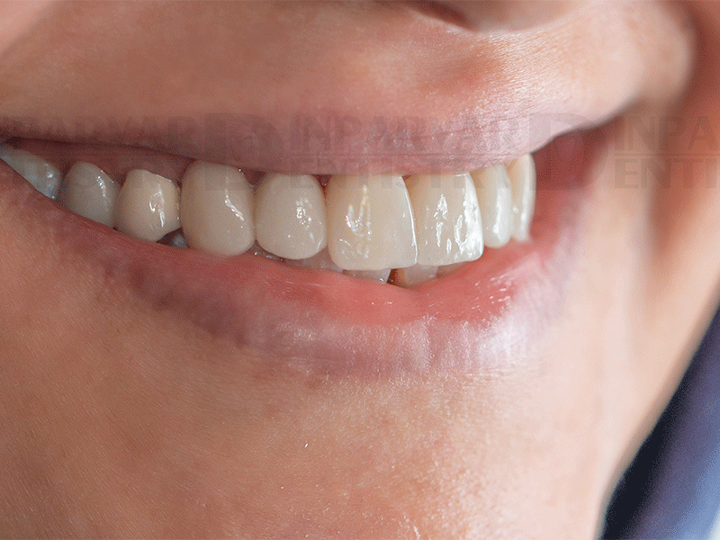 اصلاح لبخند با بلیچینگ یا سفید کردن دندان